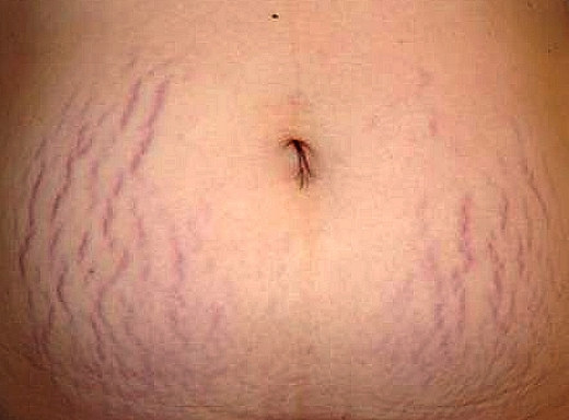 Guide for Stretch Mark Prevention | hubpages