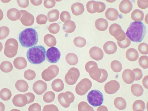 Chronic Lymphocytic Leukemia cells, large purple stained cells, amongst normal cells. Source: Wikimedia Commons, VashiDonsk, CC BY-SA 3.0. 