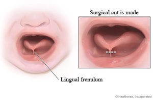 The Frenulum is located between the tongue and the lower part of your mouth, a small bit of tissue is cut to allow the tongue to move freely