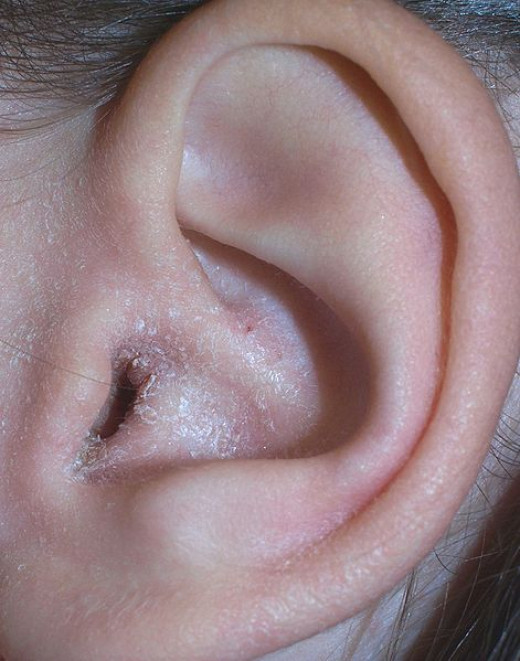 How to Treat Fungal Ear Infections