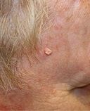 Squamous cell skin cancer