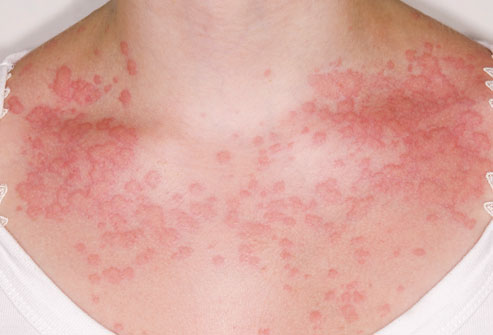 Food Allergy rash