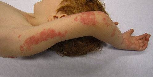 Shingles in a child.