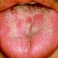 oral yeast infection