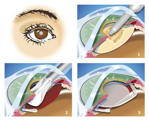 Cataract Surgery Procedure