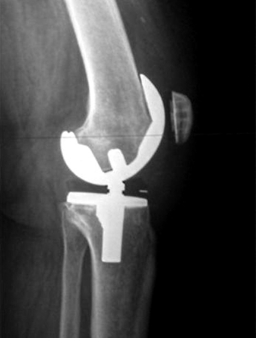 Total Knee Replacement Surgery Recovery Time and What to Expect hubpages