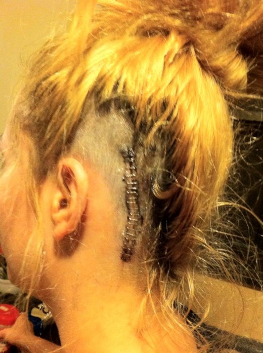 Caitlin's incision.
