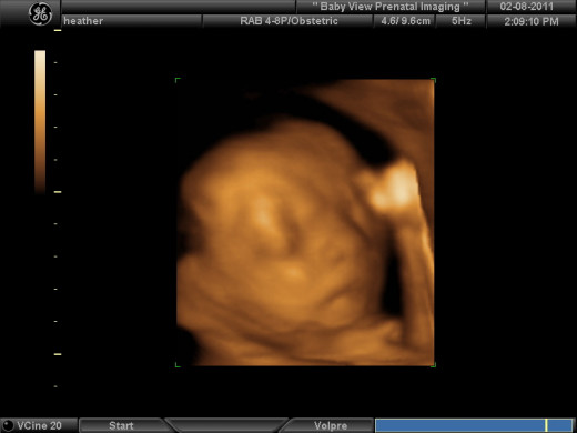 3-D Ultrasound at 21 weeks - Does not look like a blob of tissues