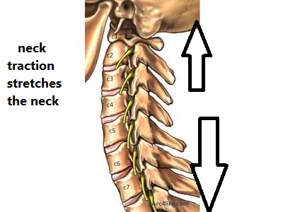 Often times patients start doing neck traction in the Physical therapist or chiropractors office, they can continue to do it at home. 