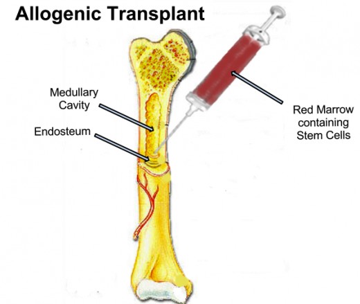 Allogeneic transplant is just one form of BMT. 