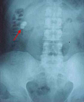 X-ray of kidney stone.