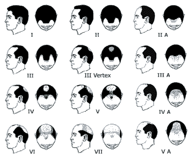 Types of Male Pattern Baldness