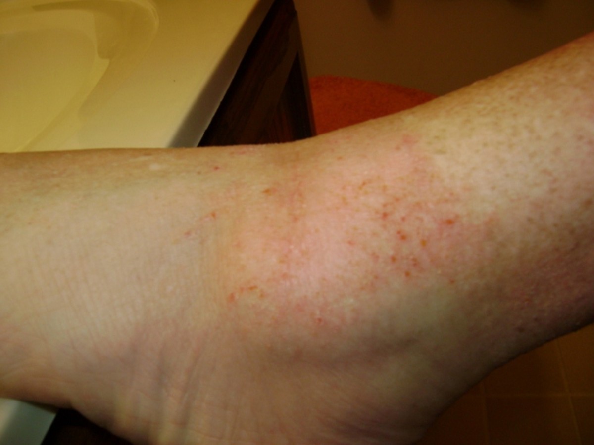 My Topical Steroid Withdrawal Red Skin Syndrome Story Hubpages