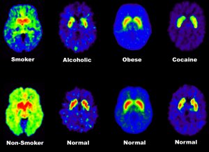 These PET brain scans show that that addicts have fewer than average dopamine receptors in their brains, so that weaker dopamine signals are sent between cells.