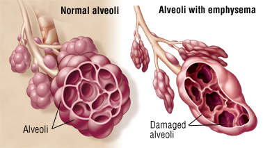 Damage to the alveoli