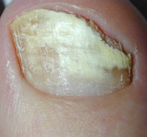 How I Cured My Fungal Toes, or Onychomycosis How I Cured My Fungal Toes, or Onychomycosis
