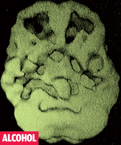 The two craters at the top of this scanned image show areas of the brain where the blood vessels have shut down or closed up, resulting in dead spots where cells have died off, particularly in the prefrontal cortex, due to alcohol abuse.