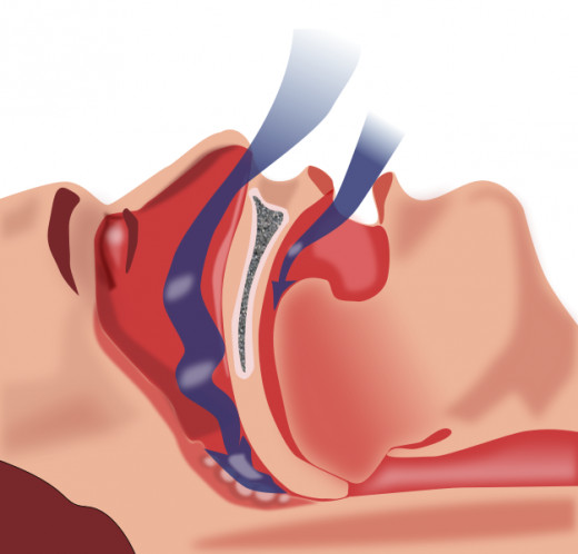 Obstruction of Airway Restricting Breathing