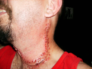 Scar after staples were removed from the surgery referenced above.