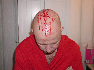 Blood coming from my scalp caused by vomiting which was caused by the chemo therapy I underwent.
