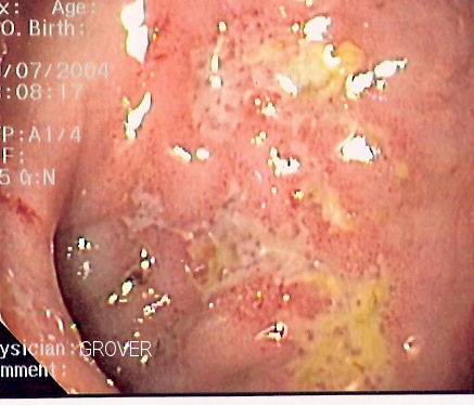 Endoscopy image of colon showing serpiginous ulcer, a classic finding in Crohn's disease