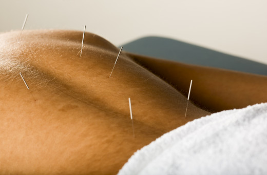 Hysteria - Acupuncture to relieve symptoms and perceived pain. 