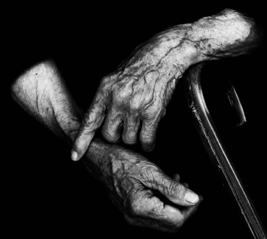 When the medium-sized arteries like the radials are nodular and thickened, it suggests medial sclerosis (Mockeberg's sclerosis), which is generally seen with advancing age.