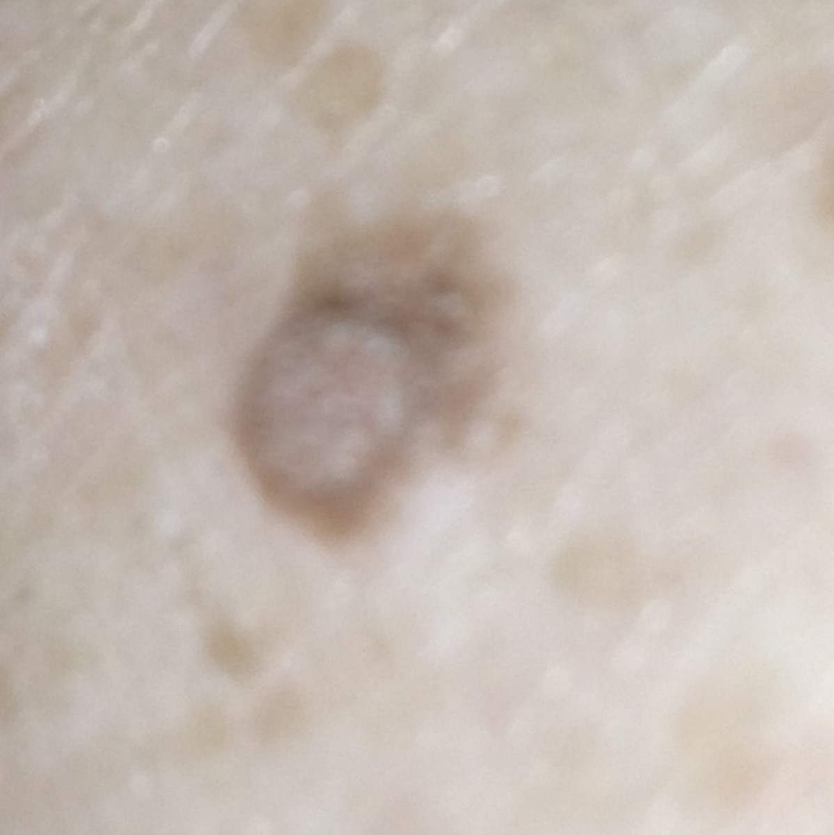 Skin Cancer Found