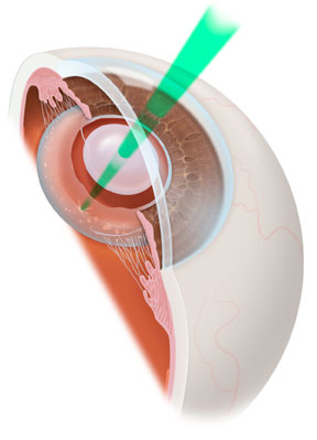 Laser treatment on a secondary cataract