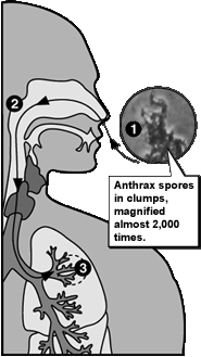 Inhalation anthrax