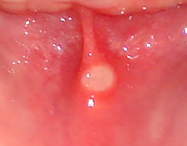 Mouth ulcers can be painful