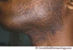 Darkening of the skin in the areas that are shaved. Velvet appearance of razor bumps around the shaved areas.