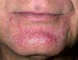 Razor bumps can appear as red rashes on the chins and other areas that have been recently shaved.