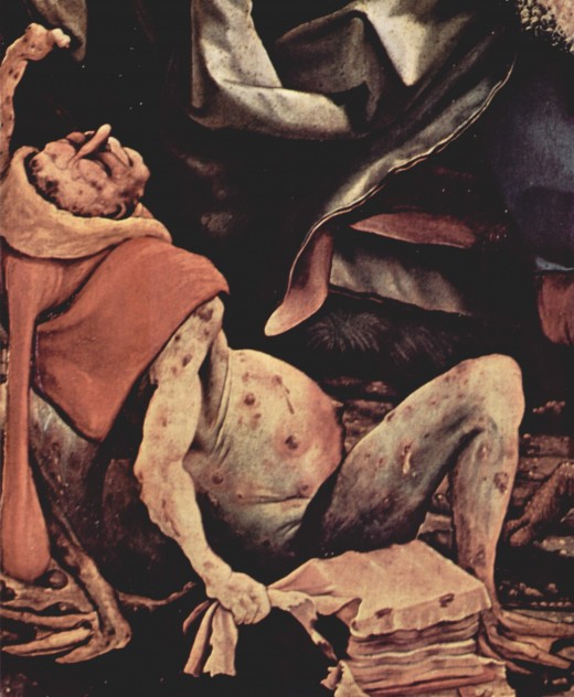 Painting by Matthias Grünewald of a patient suffering from advanced ergotism in sixteen century.