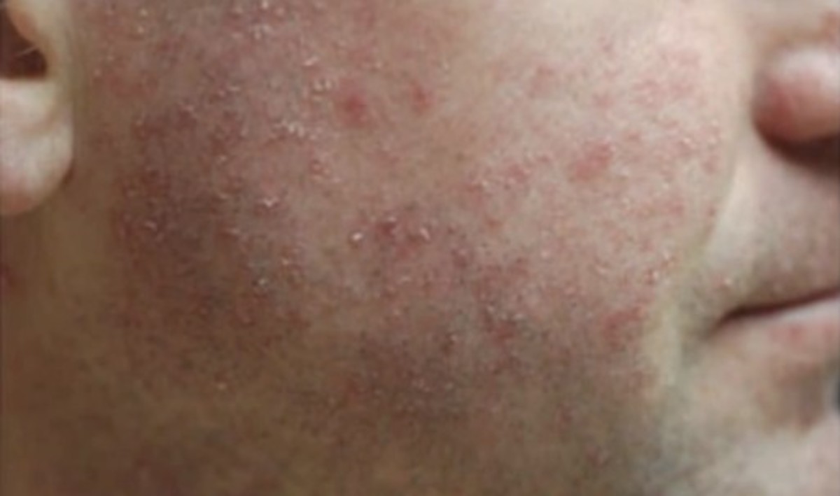How Do I Treat a Rash from Antibiotics? (with pictures)