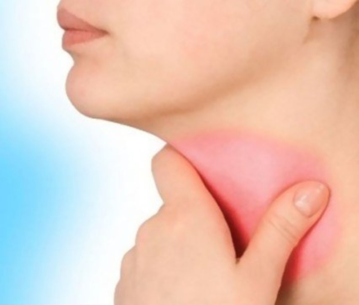 Sore Throat And Swollen Glands Causes And Treatment Hubpages