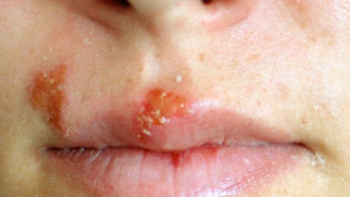 Cold Sores On Lips Pictures Causes Treatment Home Remedies