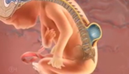 Spina Bifida Pictures, Life Expectancy, Causes, Symptoms