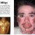 Information on  of vitiligo.
