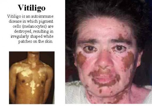Information on  of vitiligo.