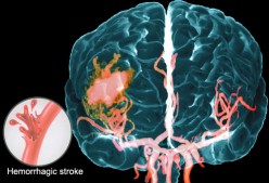 Hemorrhagic stroke