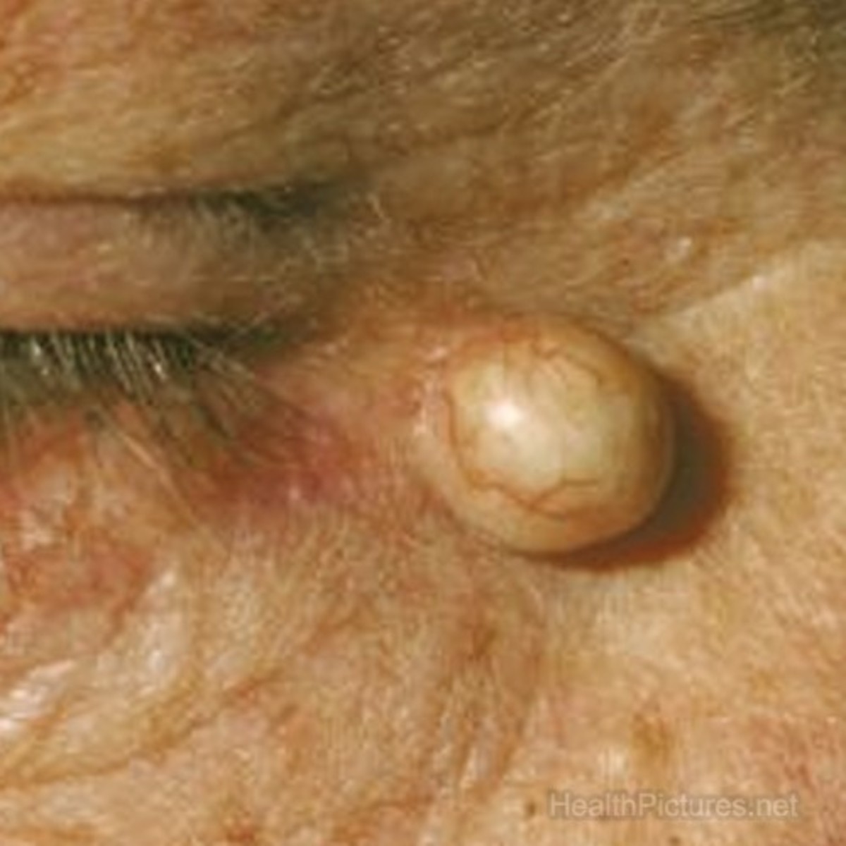 What is sebaceous prominence