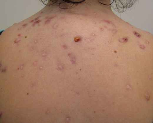 I had acne like this on my back, upper arms, neck and face