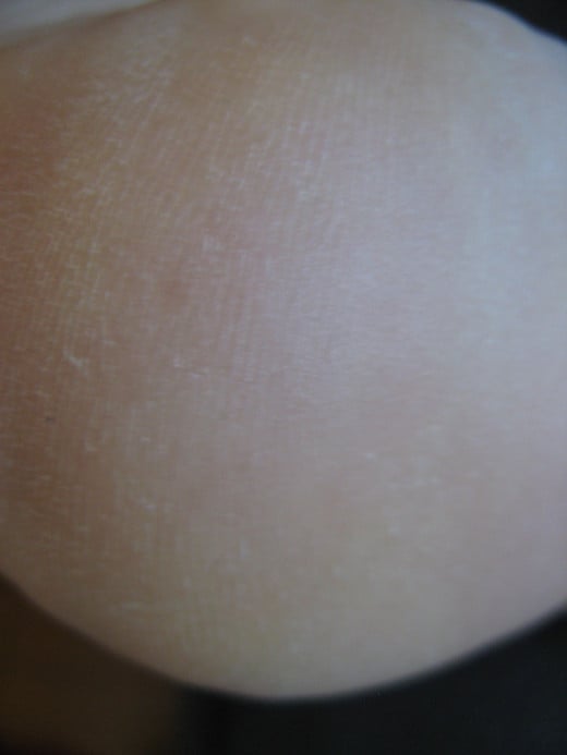 My Heel After Resetting my Low Body Temperature, heel dryness and cracks have healed completely, without lotions or abrasive treatments.