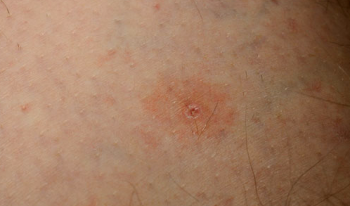 Tick Pictures, Removal, Bite Treatment and Prevention