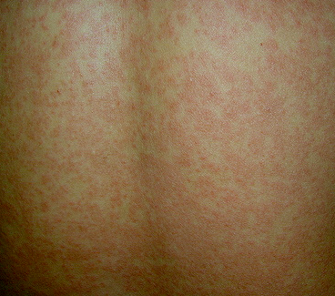 Maculopapular rash – Symptoms, Treatment, Causes, Pictures | HubPages