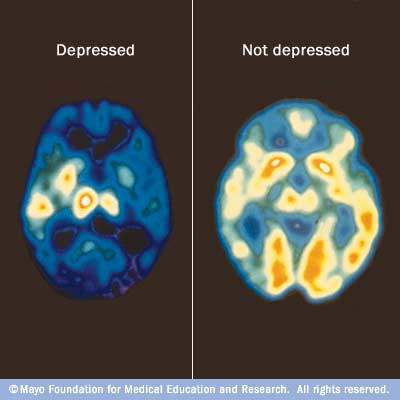 This picture shows that a depressed patient uses a limited part of the brain. The not depressed brain has a much higher capacity..