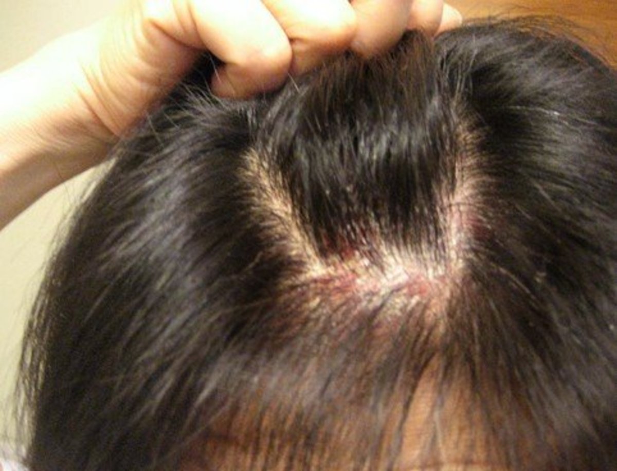 What causes scalp sores?