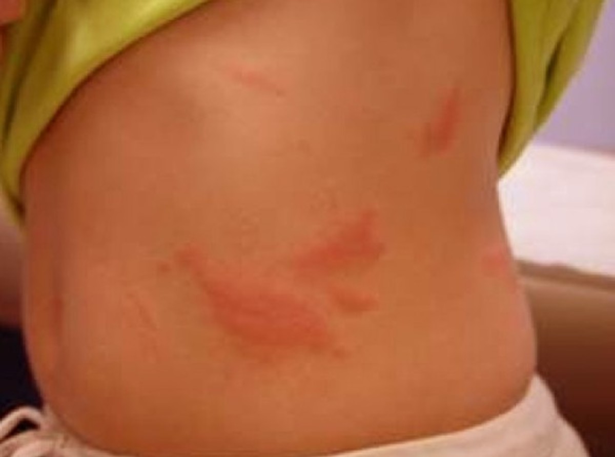 rash on lower stomach - Dermatology - MedHelp
