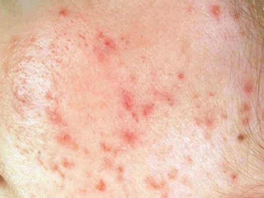 Liver Spots - Pictures, Causes, Treatment, Removal | hubpages